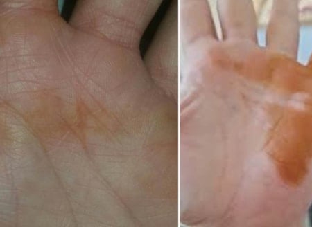 Cin düğünü diye bilinen elde kına lekesinin nedeni bakın neymiş!