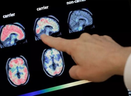 Bilim insanları "Yüzde 99 öldürüyor" diyerek açıkladı! Burundan bulaşan virüs beyni mahvediyor